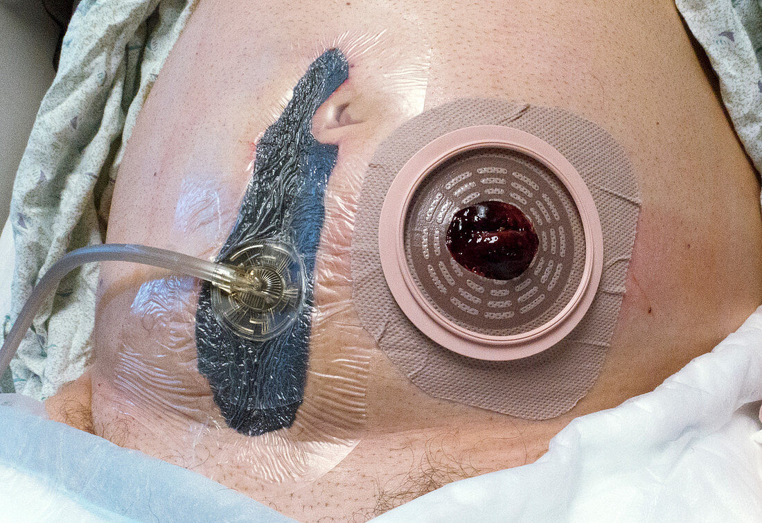 Colostomy and negative-pressure wound