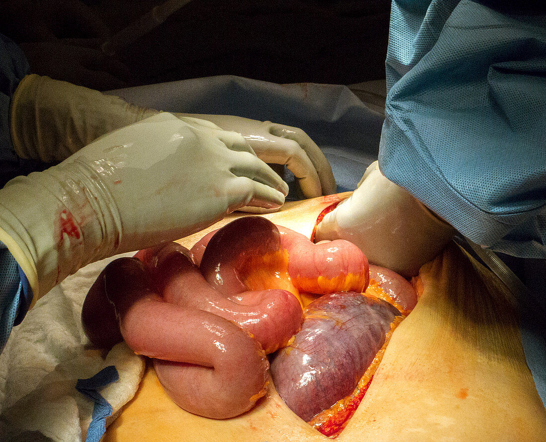 Distended colon explorative laparotomy