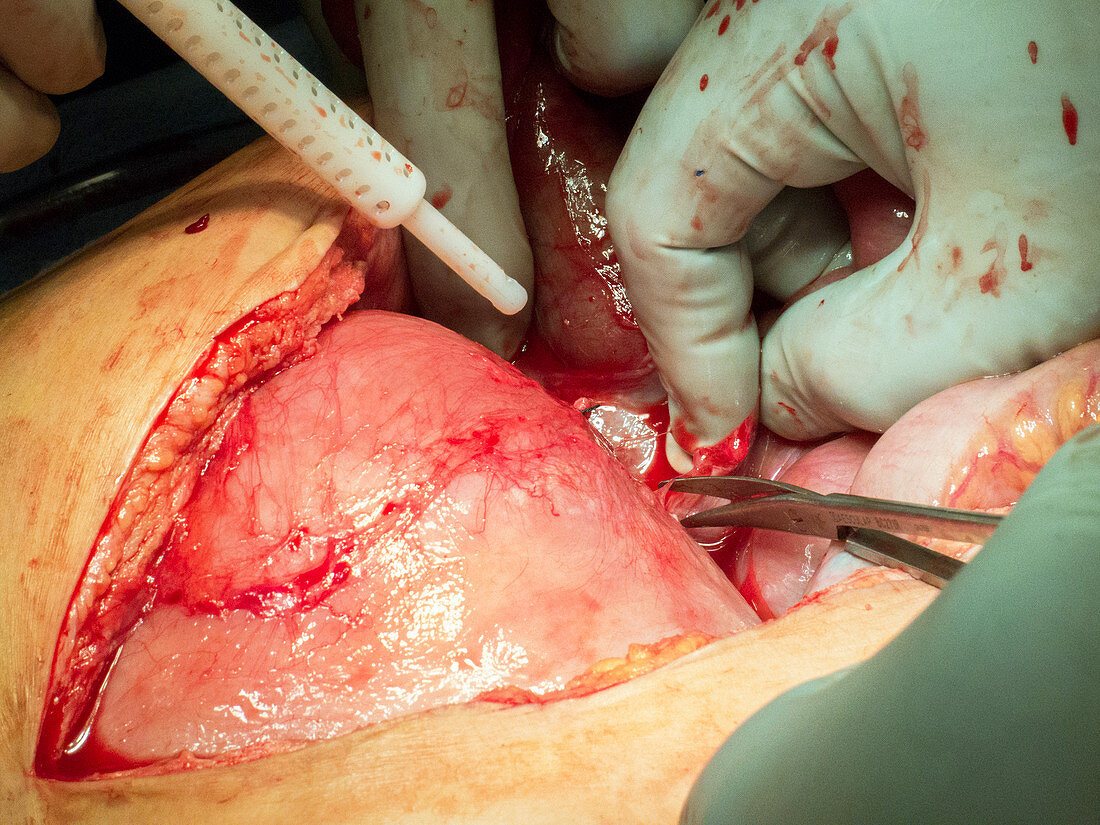 Explorative laparotomy