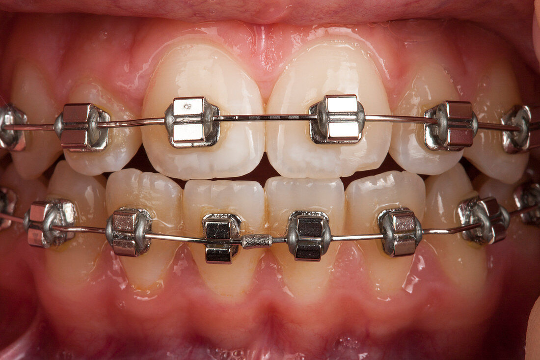 Fixed orthodontic braces