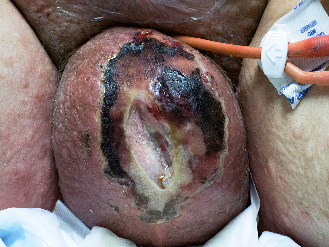 Scrotal necrosis and oedema
