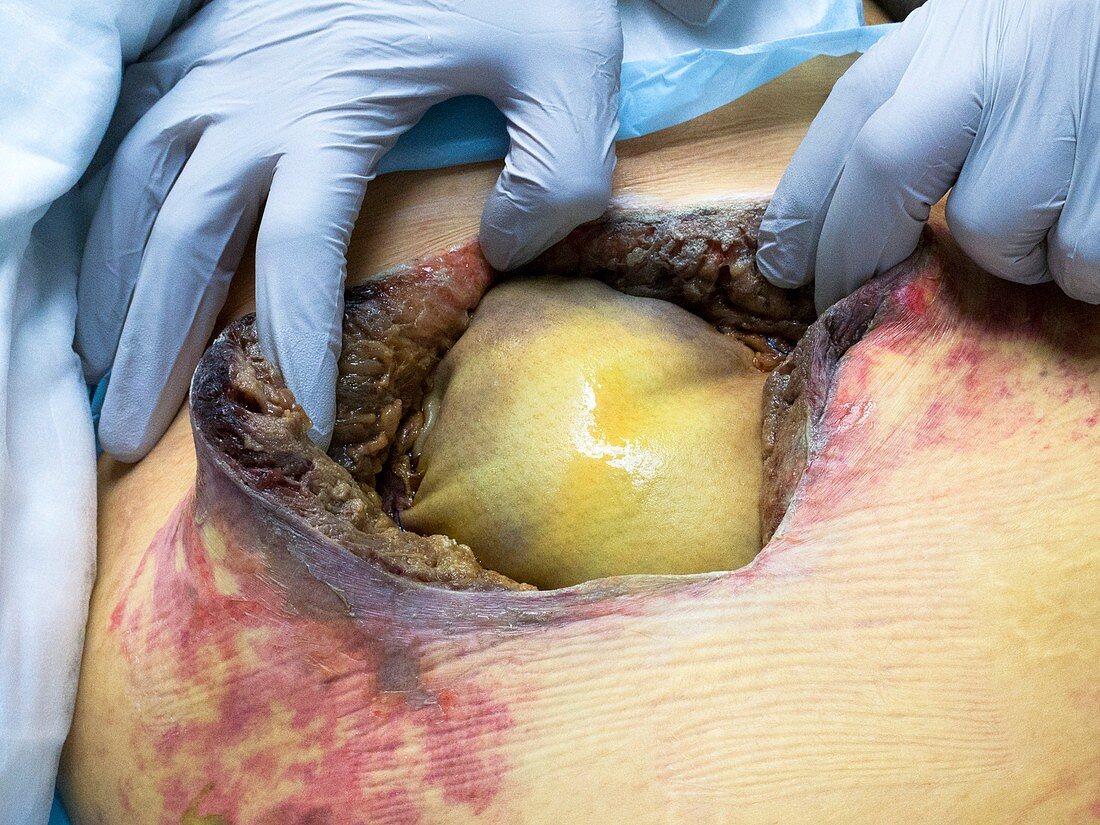 Biomesh repair of a hernia