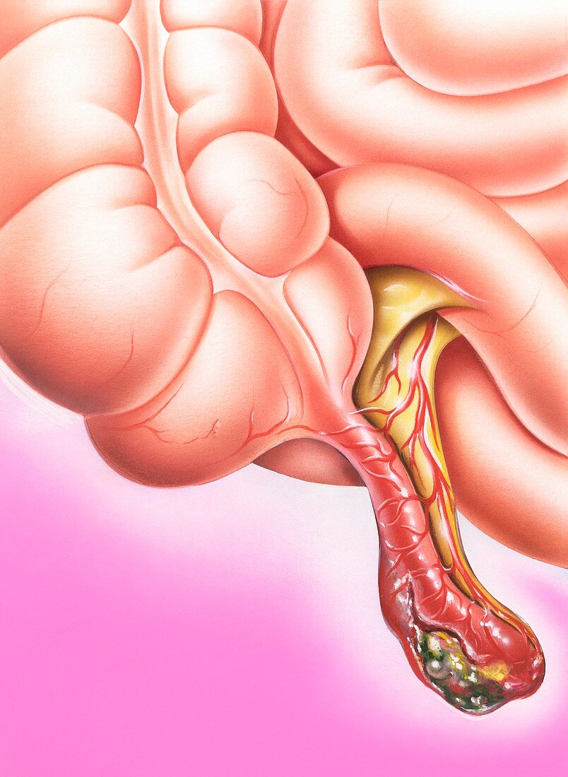 Gangrenous appendicitis,illustration