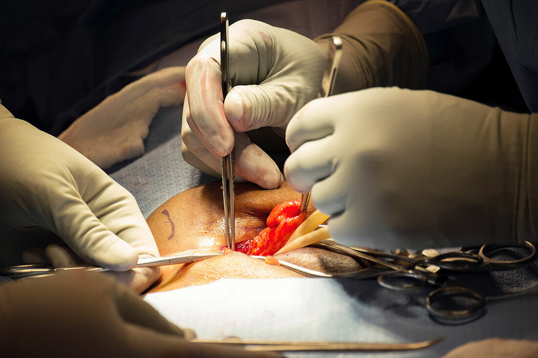 Hernia repair surgery