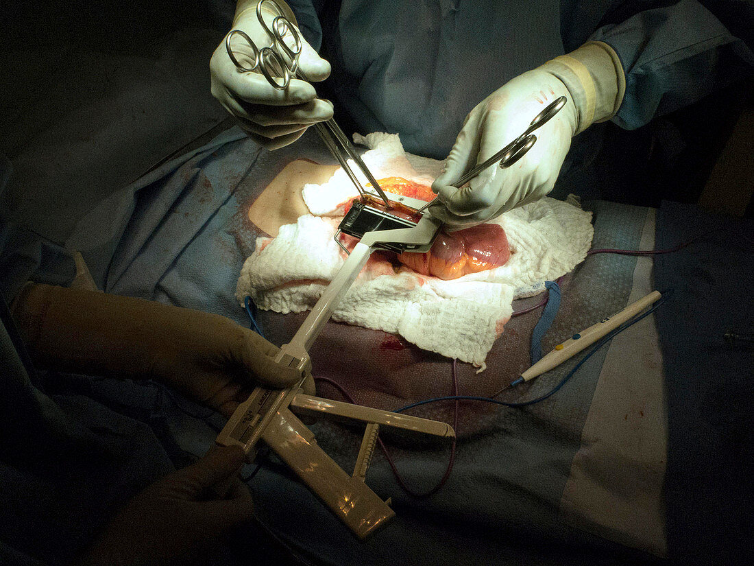 Stapler use during intestinal surgery