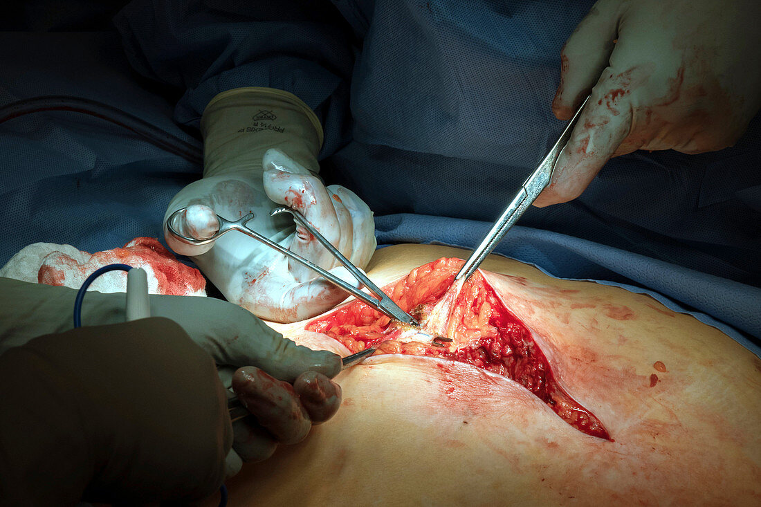 Exploratory abdominal surgery