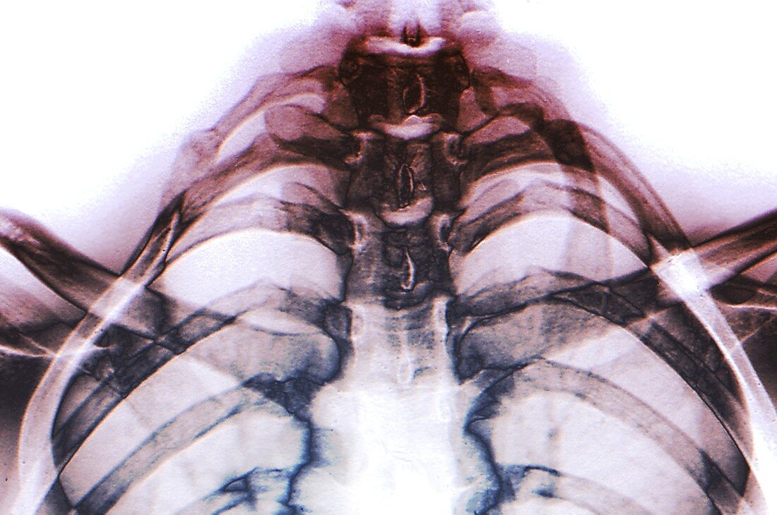Extra rib,X-ray