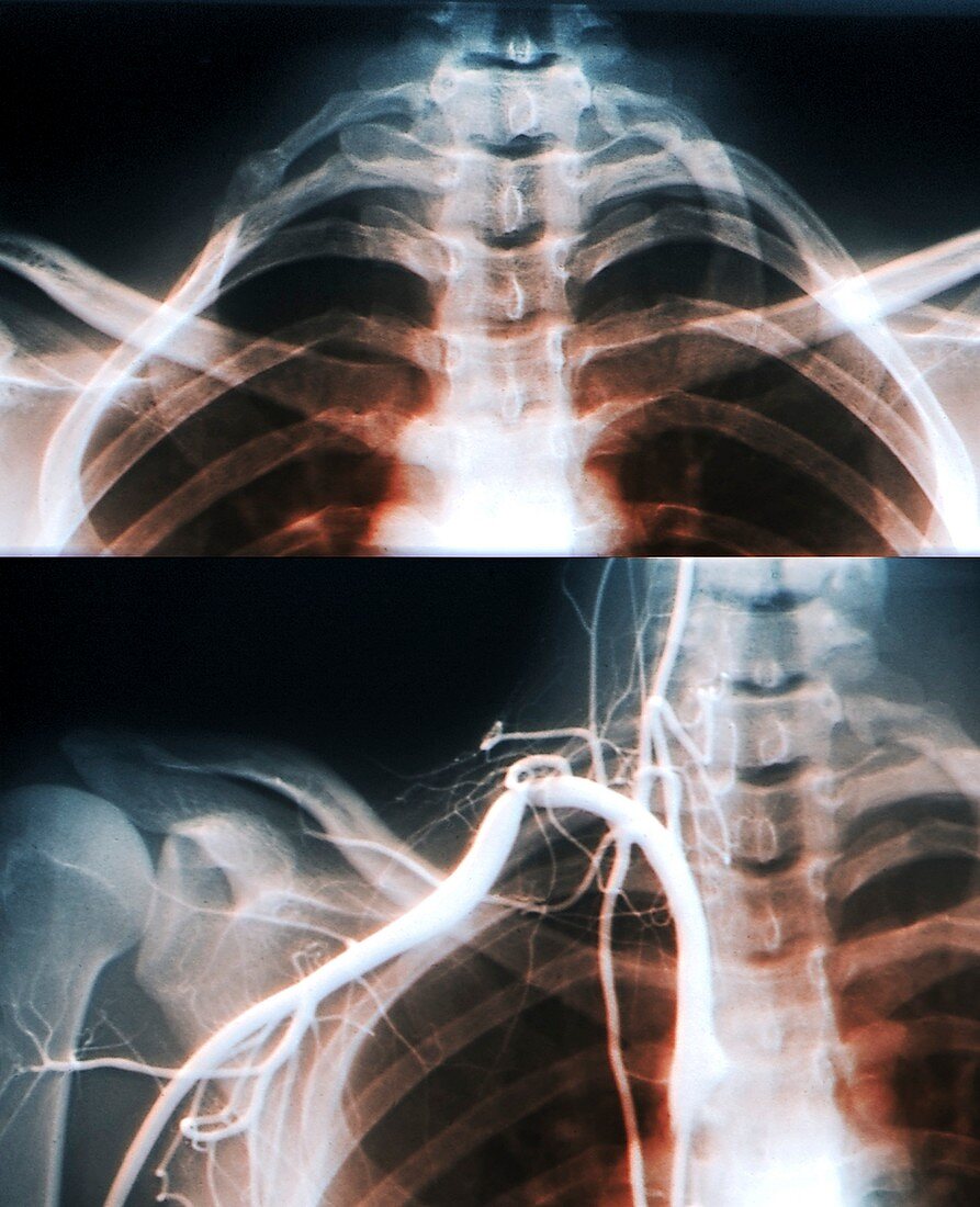 Extra rib,X-rays