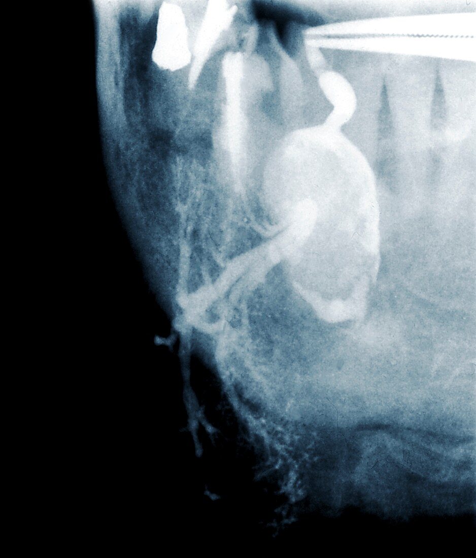 Salivary stone,X-ray
