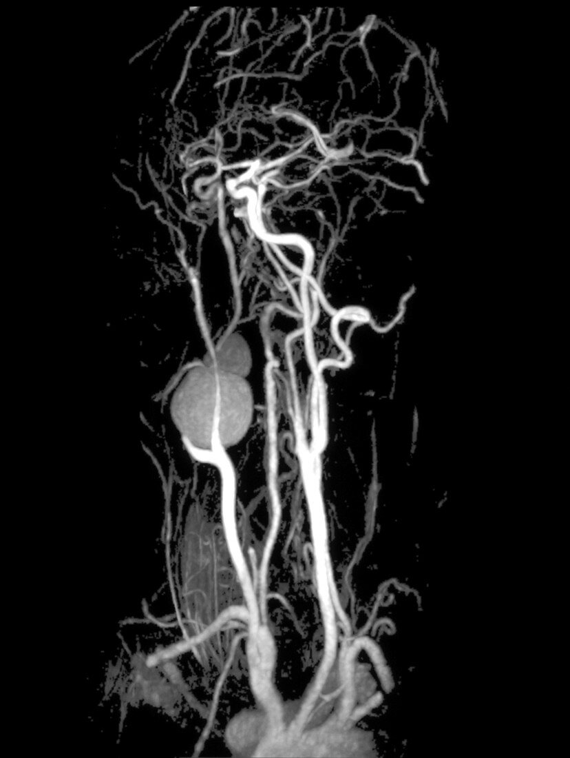 Carotid aneurysm,MRI
