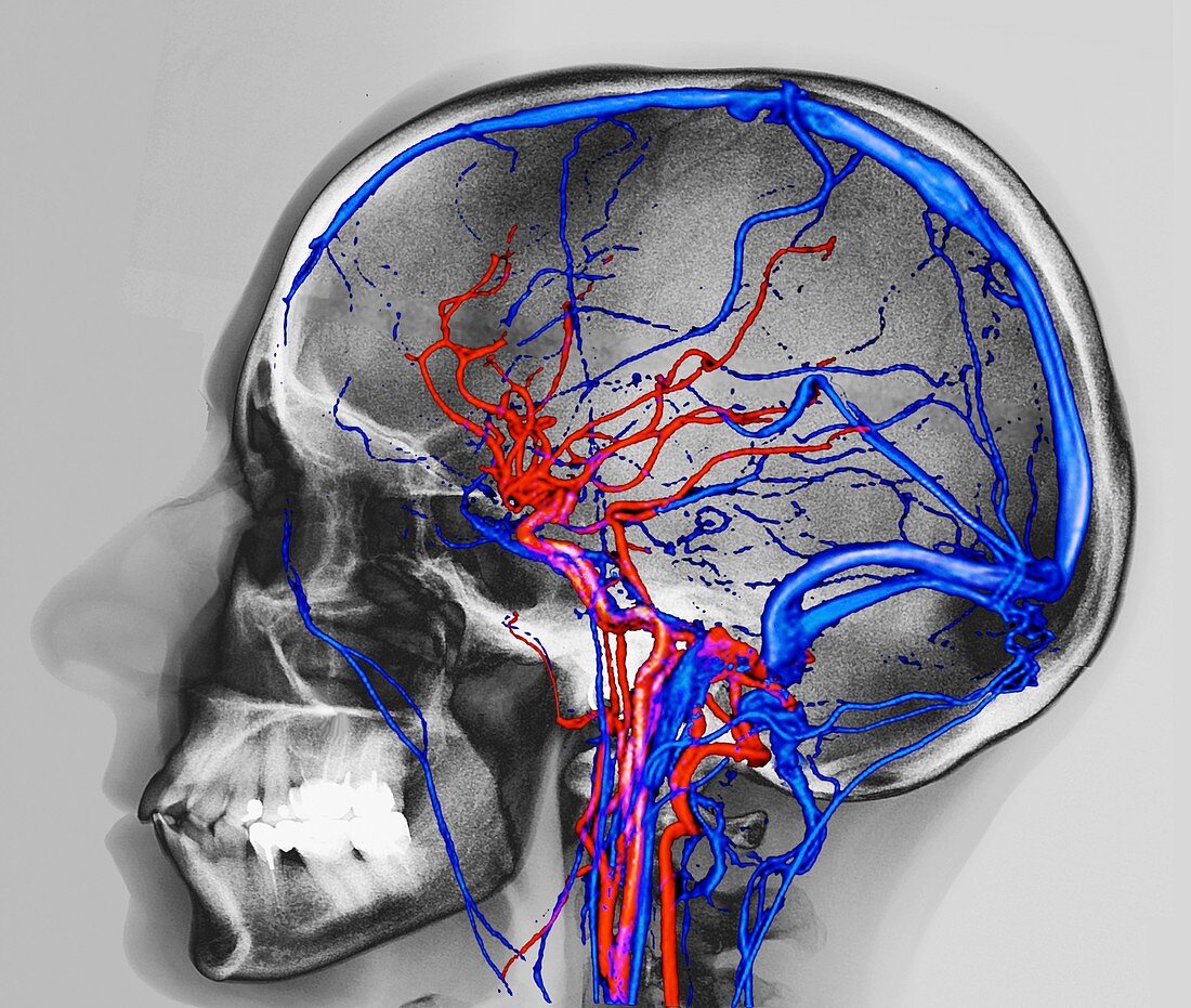Normal brain blood supply,CT scan