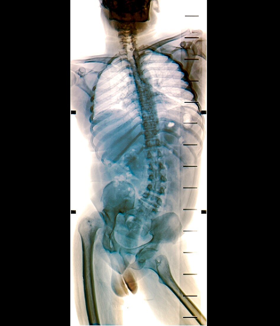 Spinal deviation in polio,X-ray