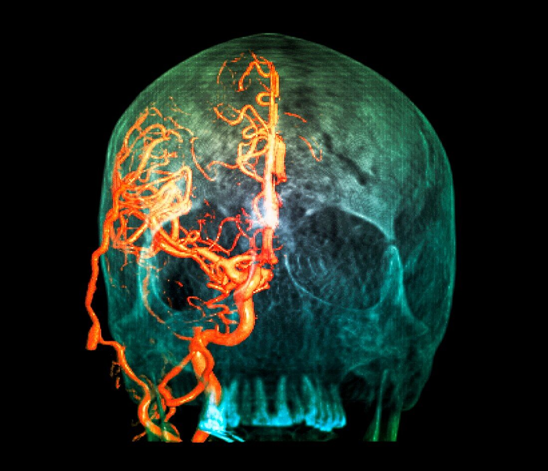 Brain haemorrhage,3D CT scan