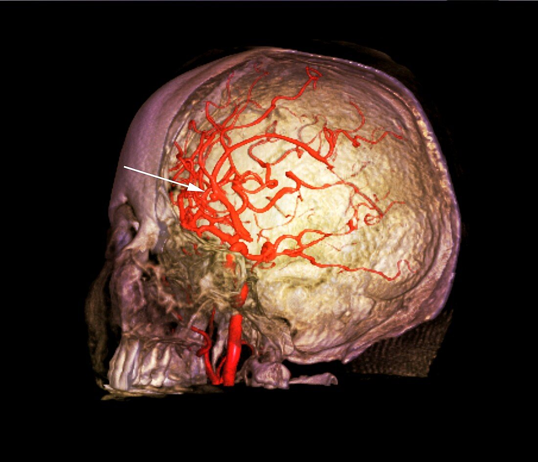 Brain haemorrhage,3D CT scan