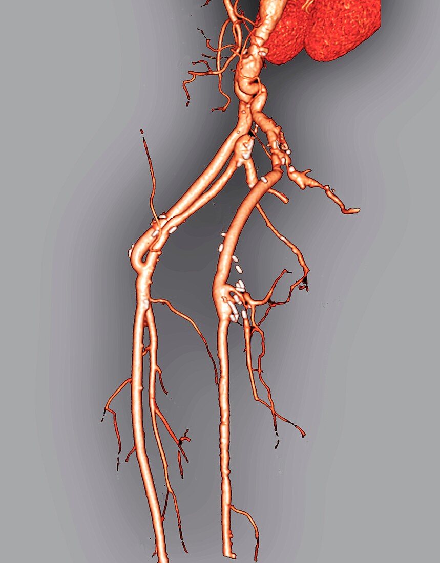 Arterial bypass,3D CT scan