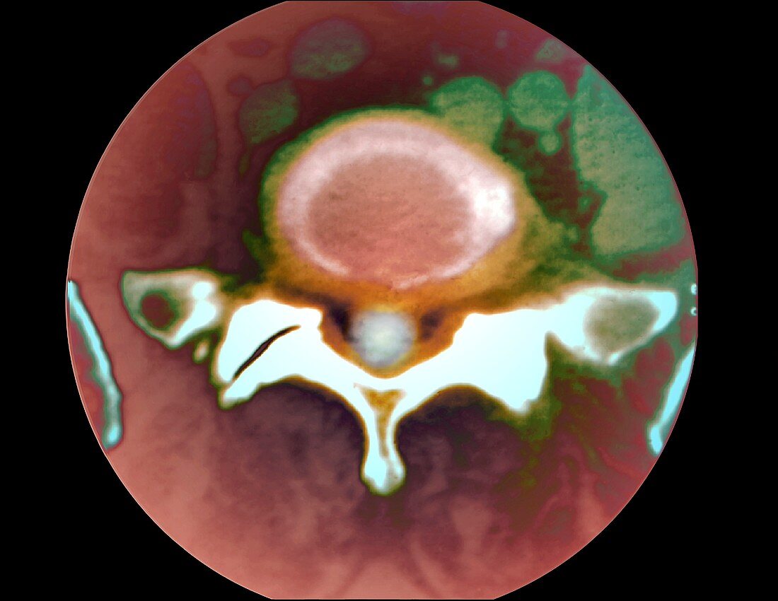 Spinal disc degeneration,CT scan