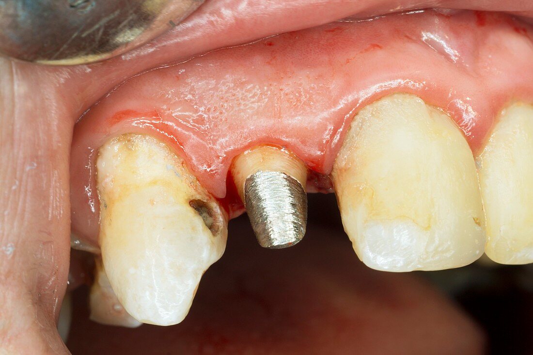 Upper incisor with post for dental crown