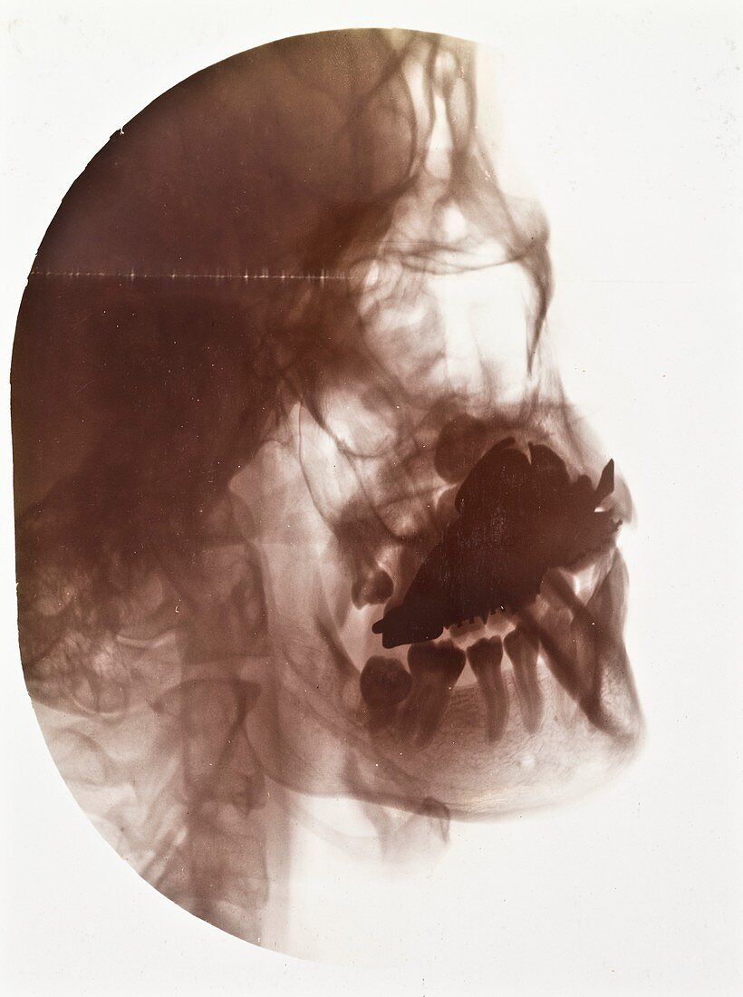 Dental implant X-ray,early 20th century