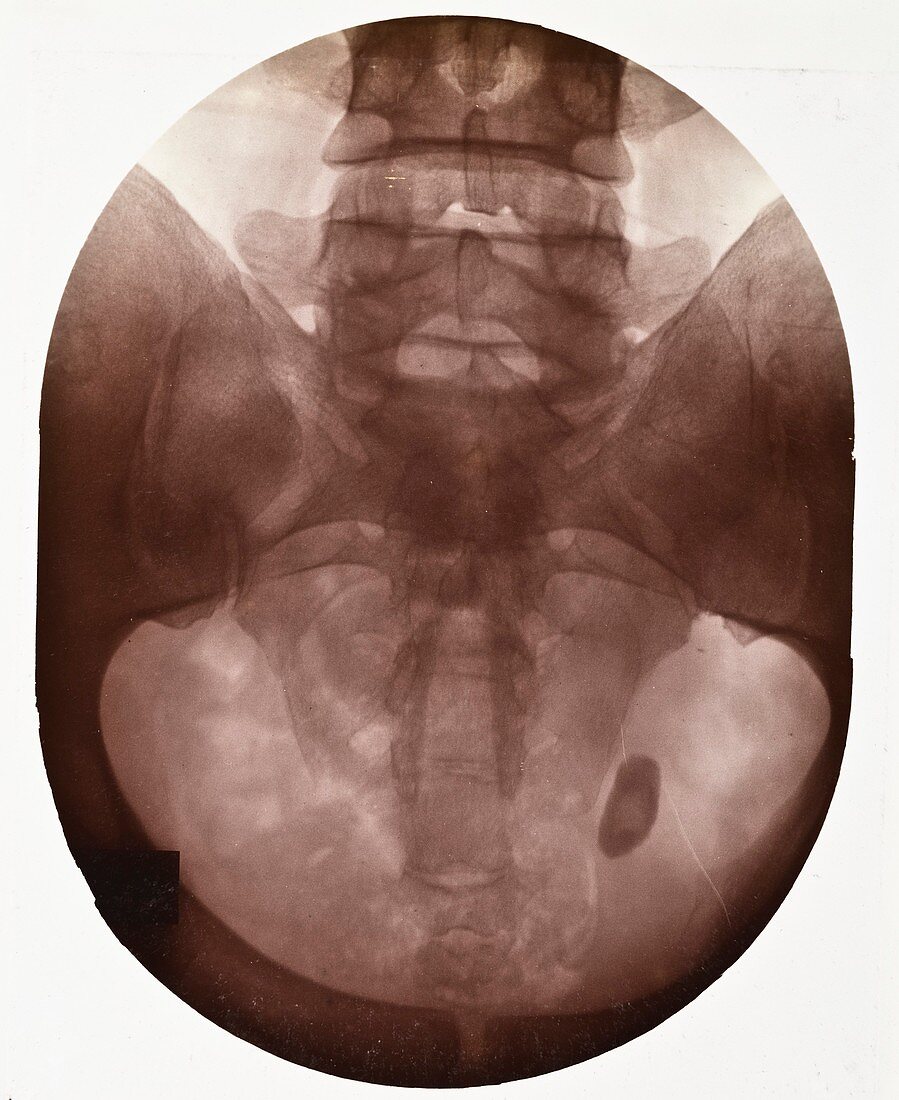 Pelvic X-ray,early 20th century