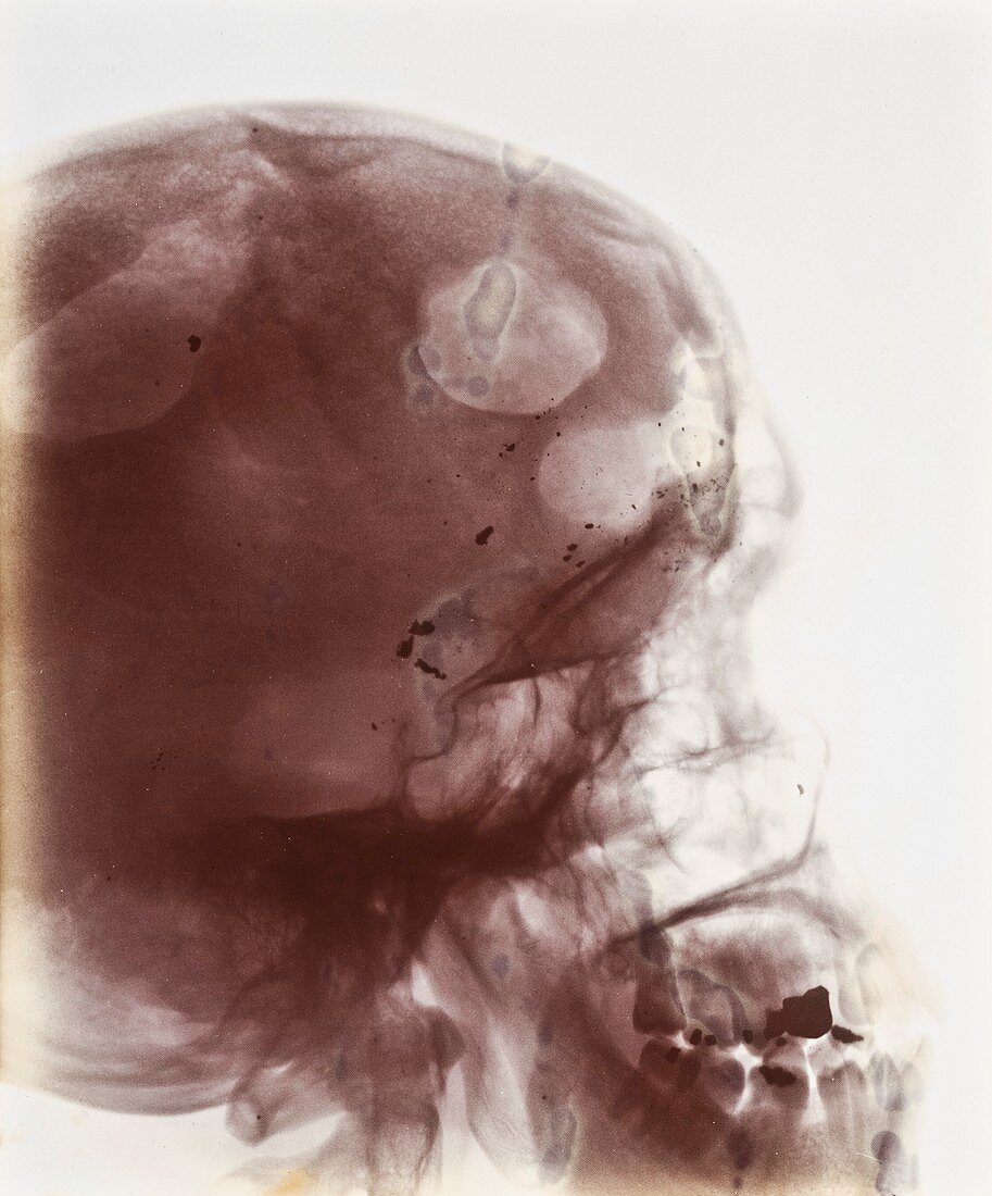 Skull injury X-ray,early 20th century