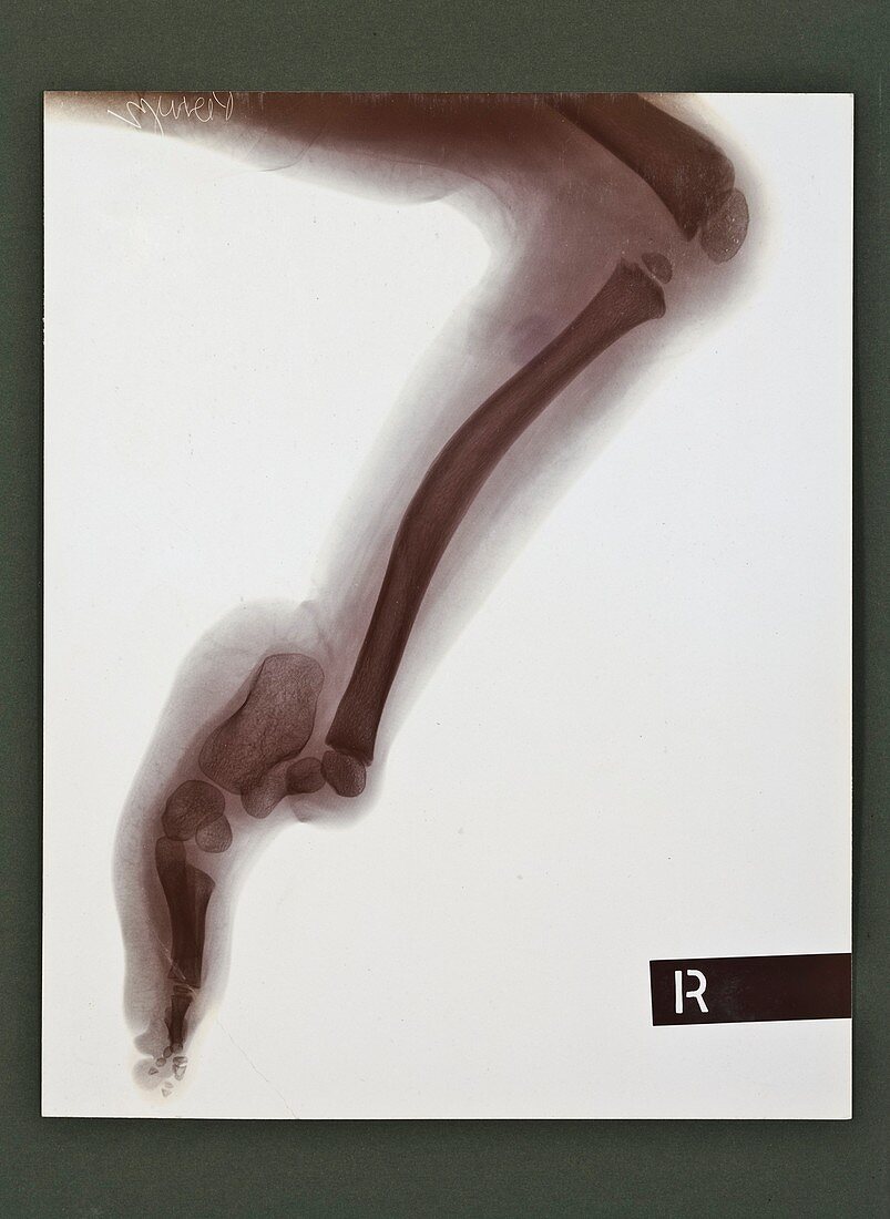 Deformed leg X-ray,early 20th century