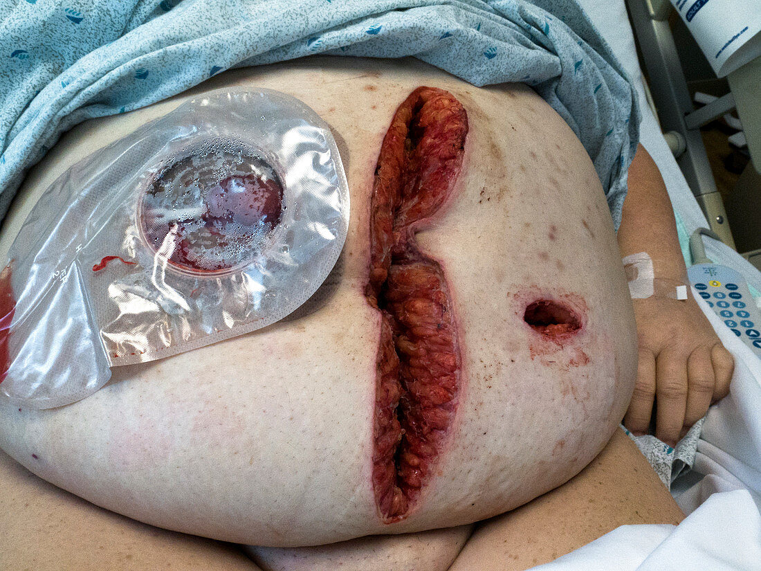 Open wound after colostomy surgery