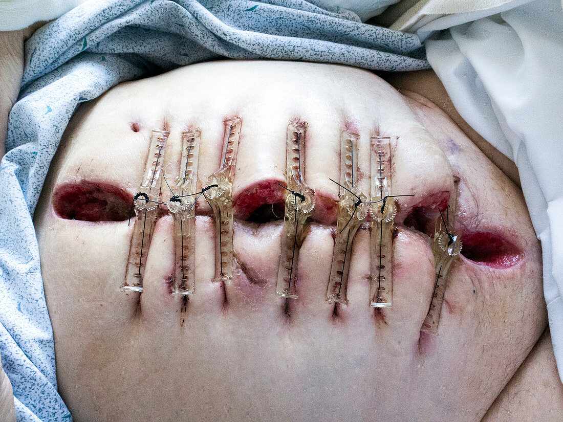 Retention sutures in laparotomy