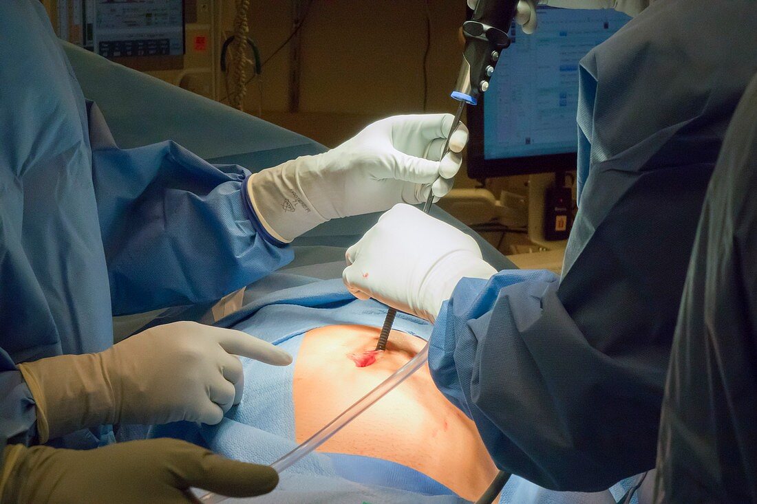 Appendix removal surgery