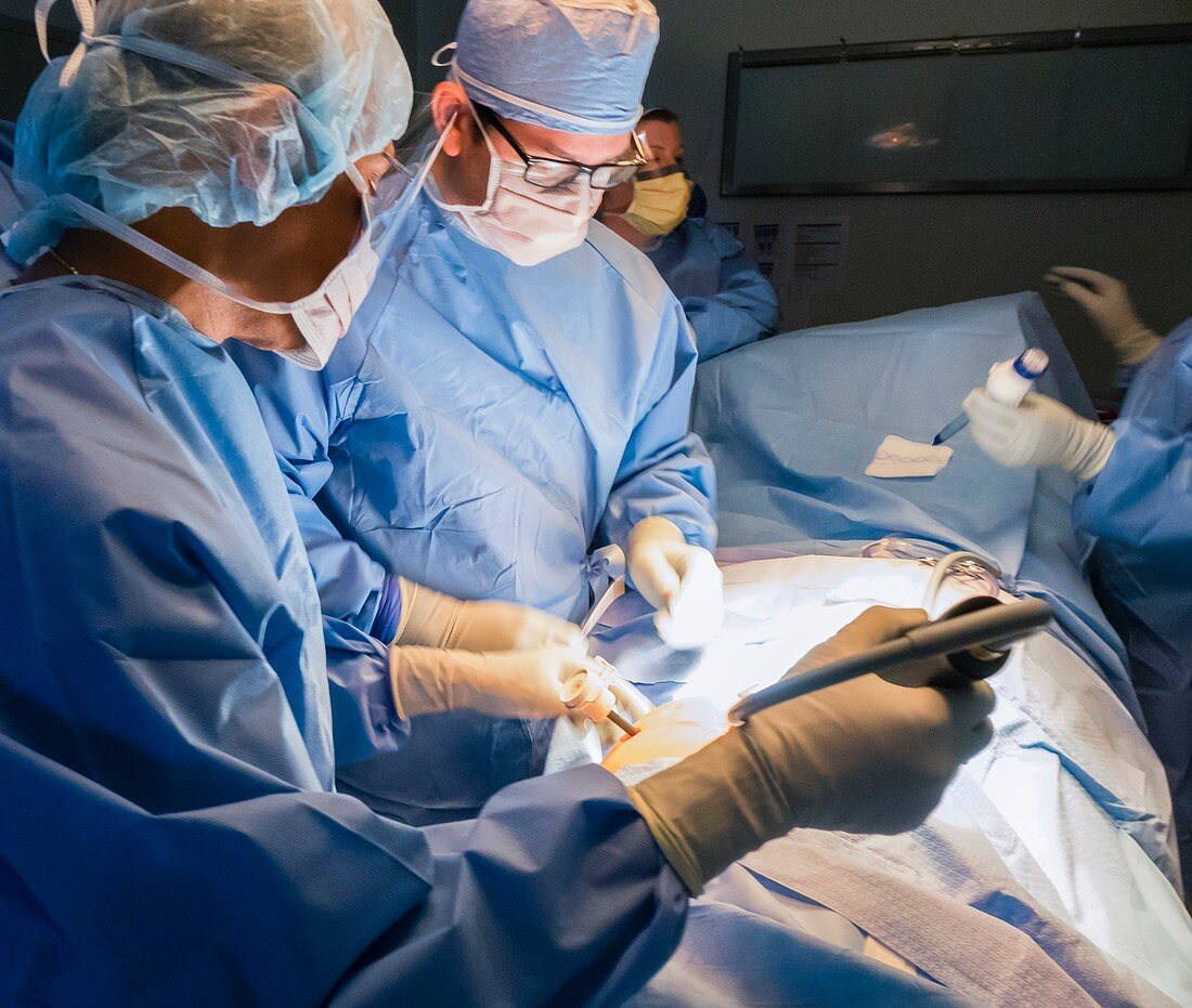 Appendix removal surgery
