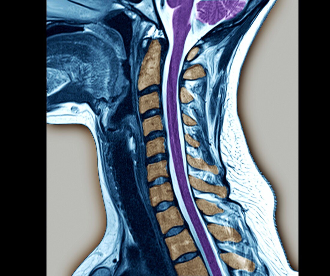 Normal cervical vertebra,MRI scan