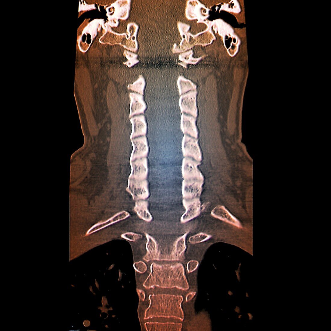 Normal cervical vertebra,MRI scan