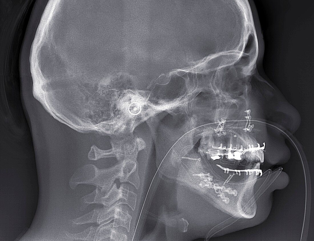 Skull after reconstructive surgery,CT