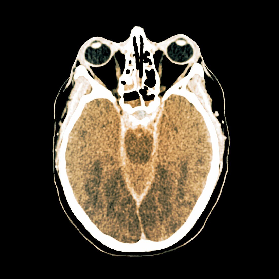 Brain death following cardiac arrest,CT