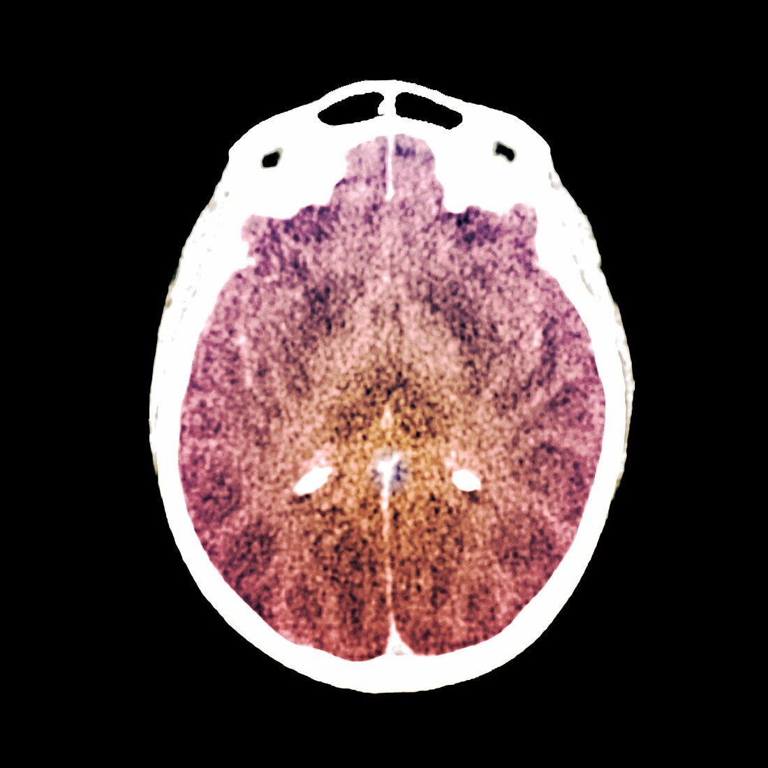 Brain death following cardiac arrest,CT