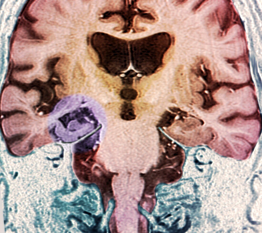 Brain in Alzheimer's disease,MRI