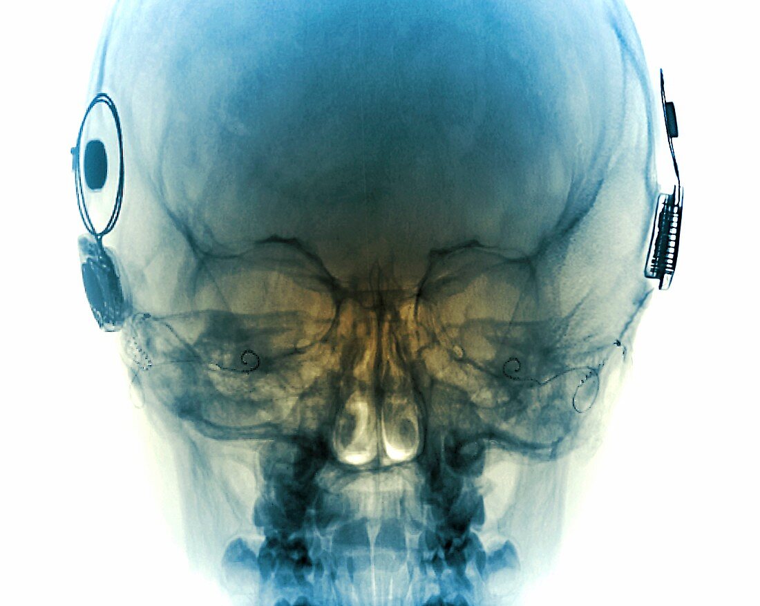 Cochlear implants,X-ray