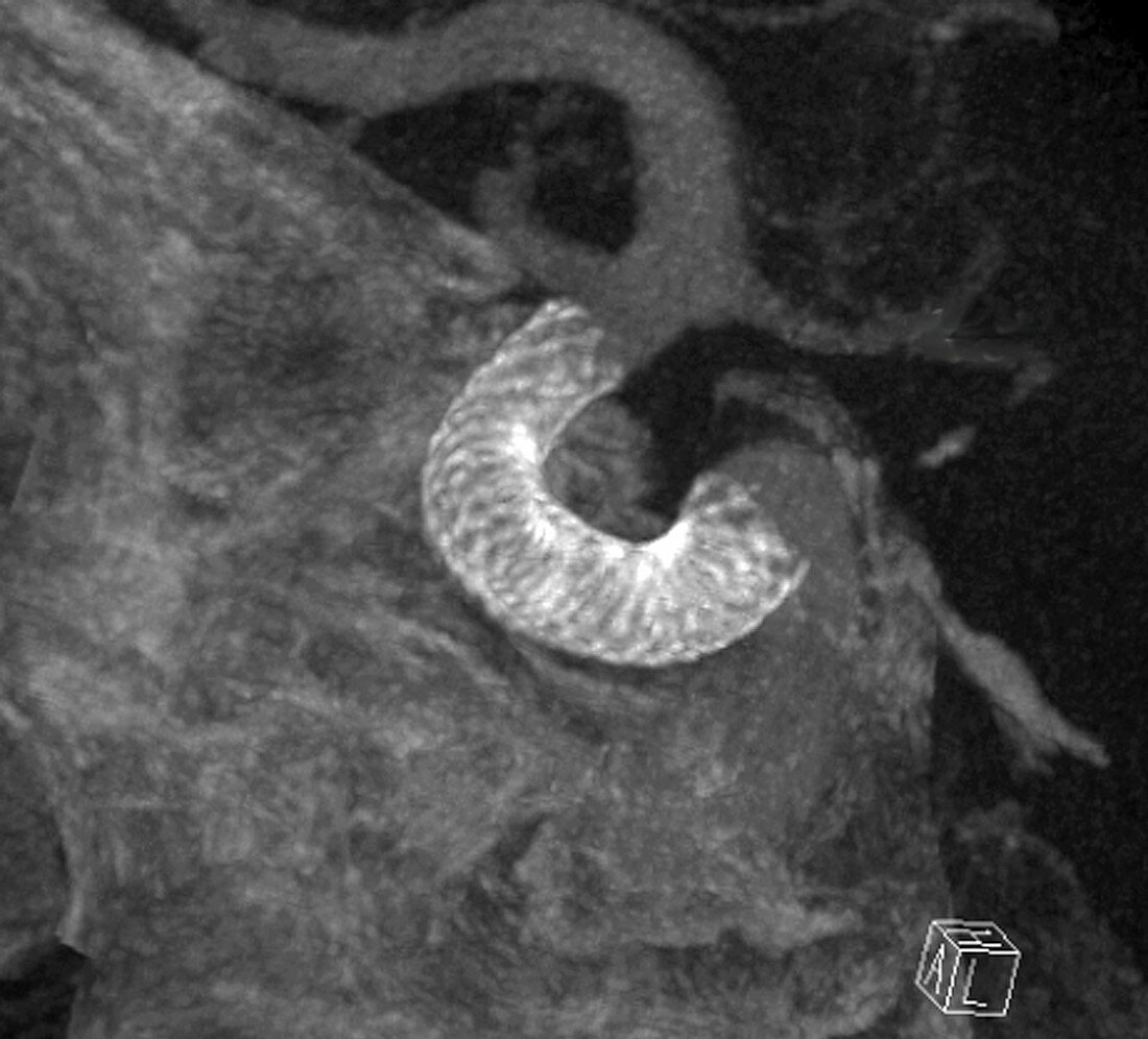 Stent in carotid aneurysm,3D CT scan