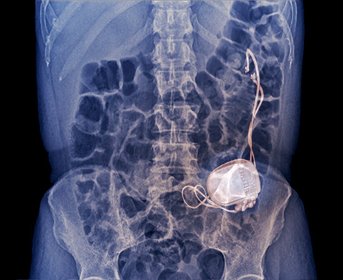 Gastric pacemaker in gastroparesis,X-ray