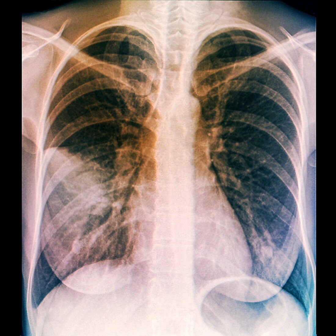 Lungs in pneumonia,X-ray