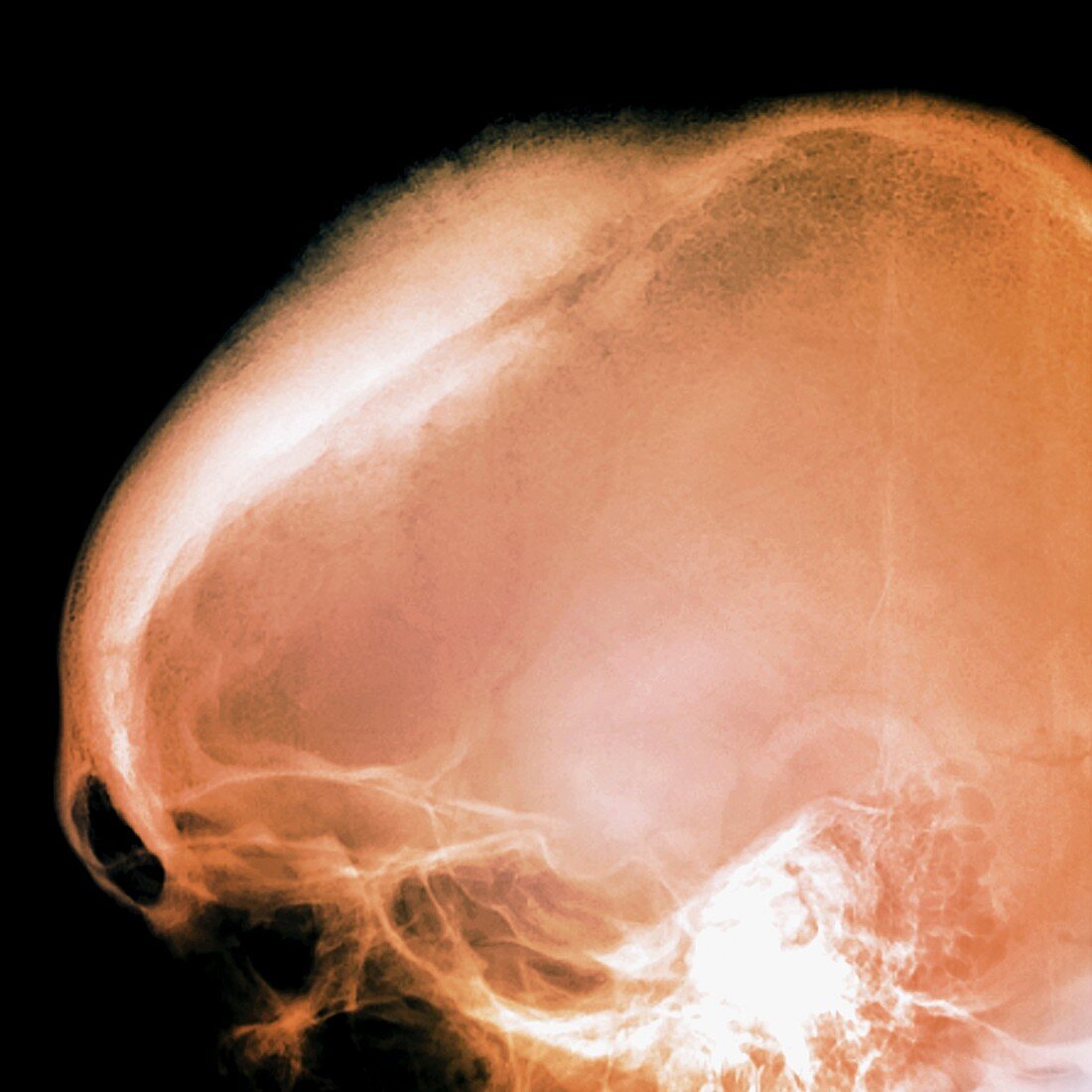 Brain tumour,X-ray