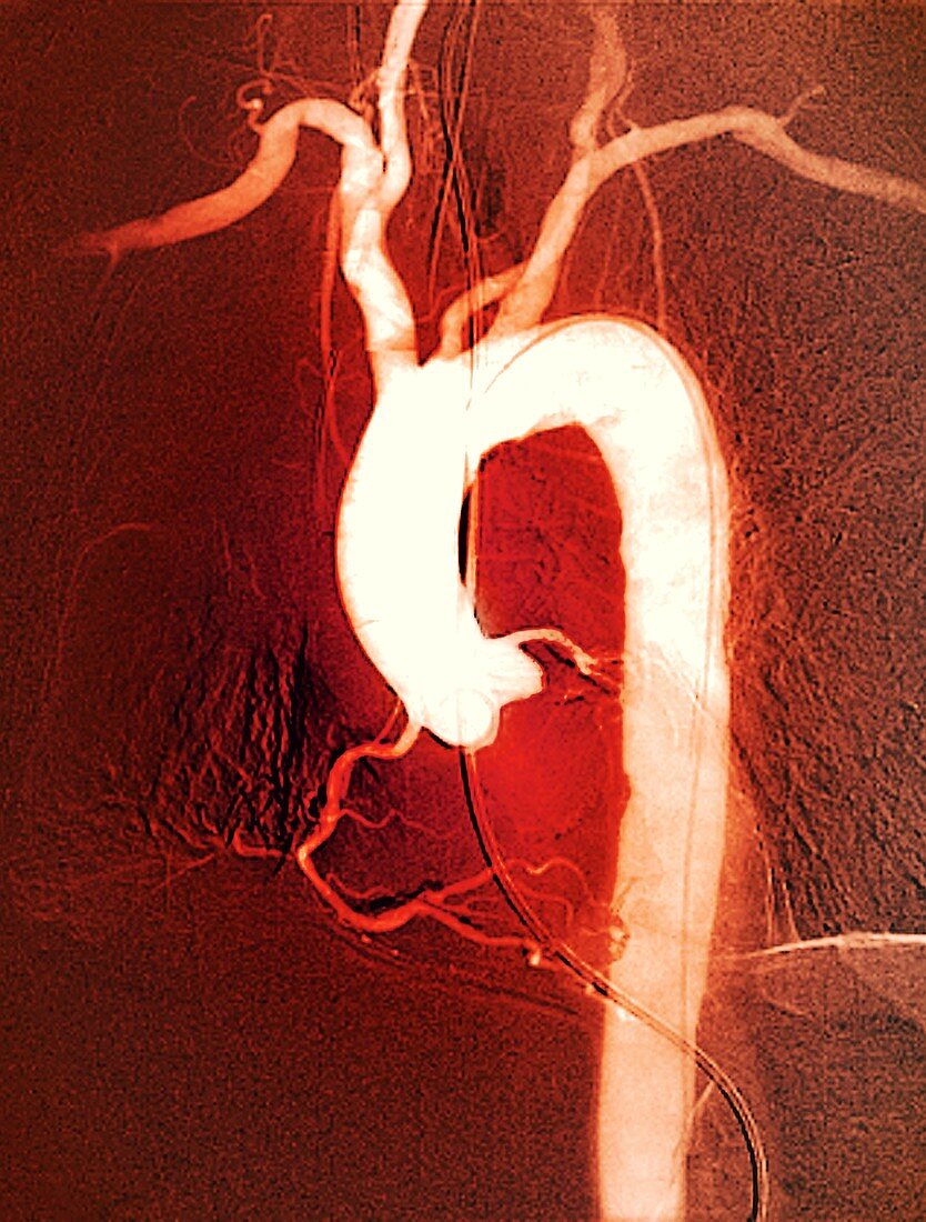 Aortic arch,X-ray
