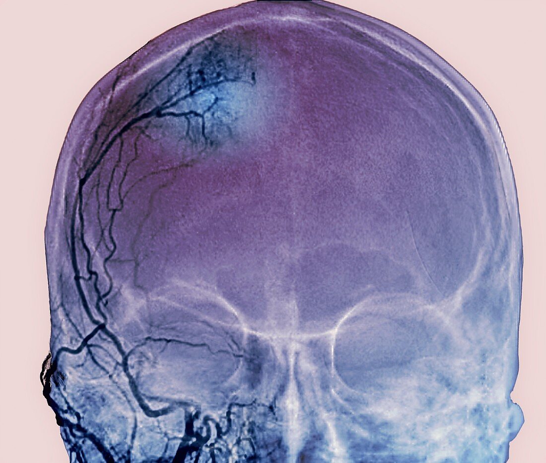 Brain tumour blood supply,X-ray and CT