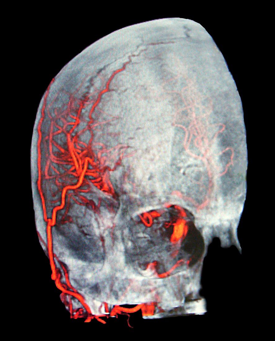 Brain haemorrhage