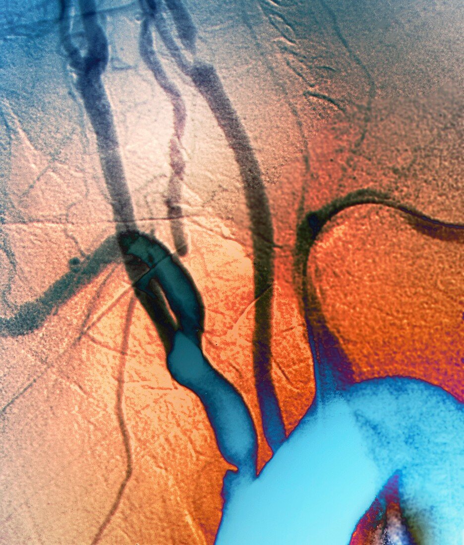 Vascular disease in smoker,X-ray