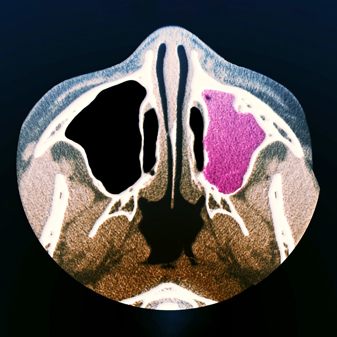 Sinus infection,CT scan