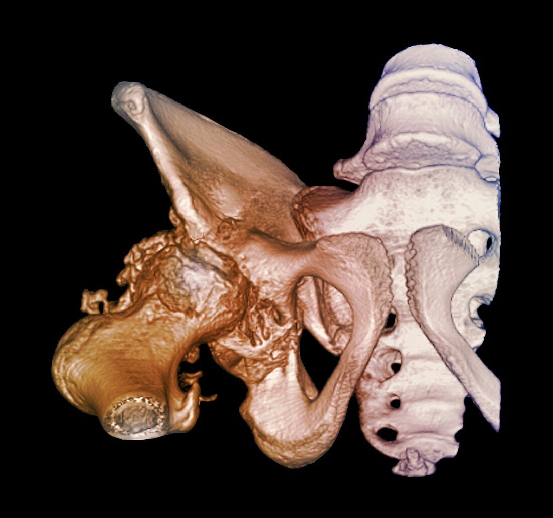 Osteoarthritis of the hip,3D CT scan