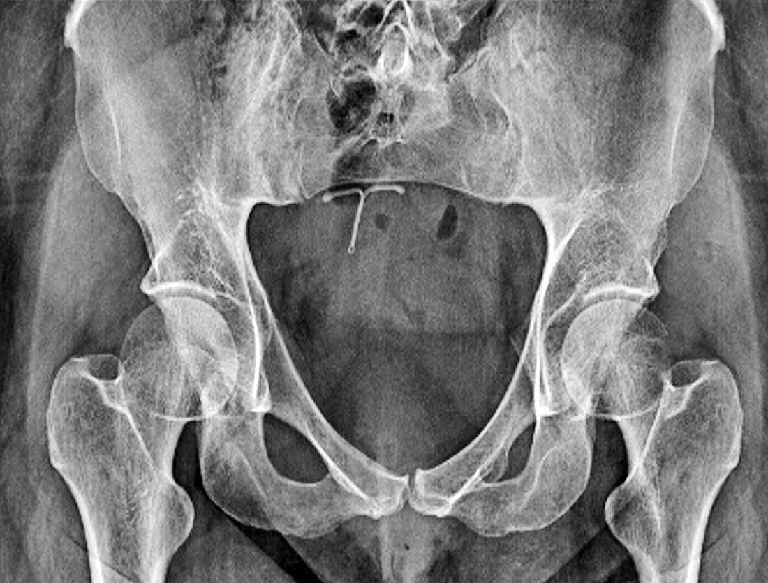 Underdeveloped pelvic bones,X-ray