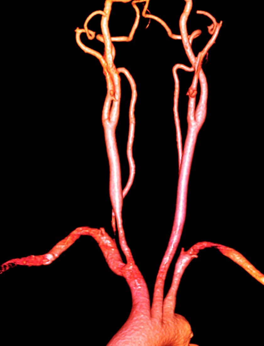 Arteries in Takayasu's arteritis,3D CT