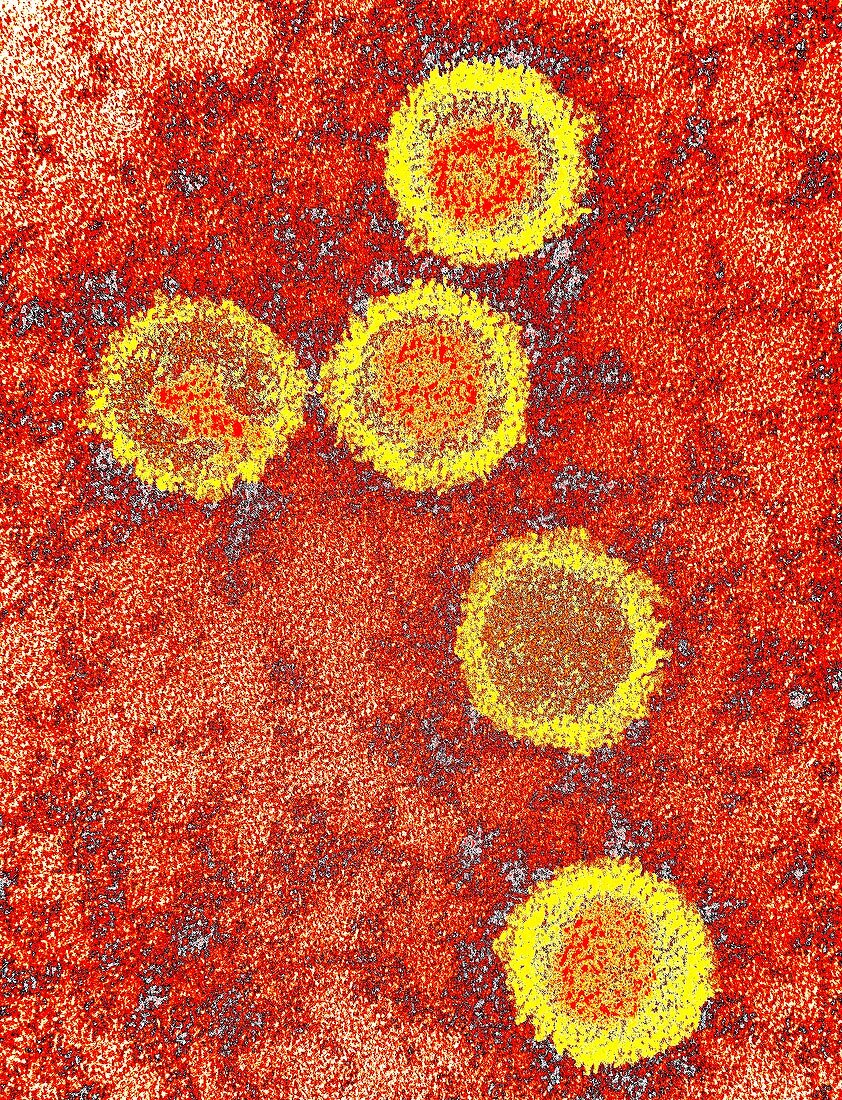 Epstein-Barr virus particles,TEM