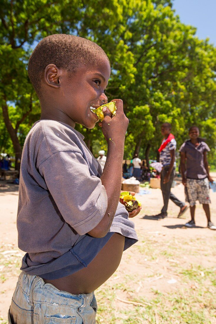 Malnourished refugee child,Malawi